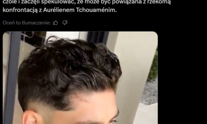 Nowa FRYZURA Fede Valverde i WIDOCZNA BLIZNA po majowym starciu z Tchouamenim!